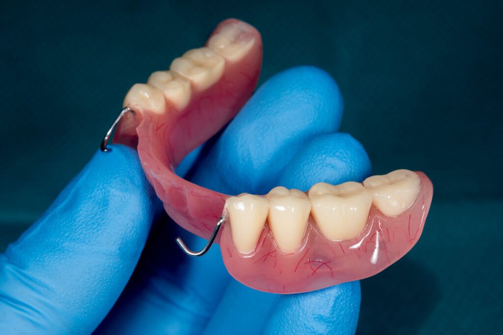 Partial removable denture of the lower jaw.