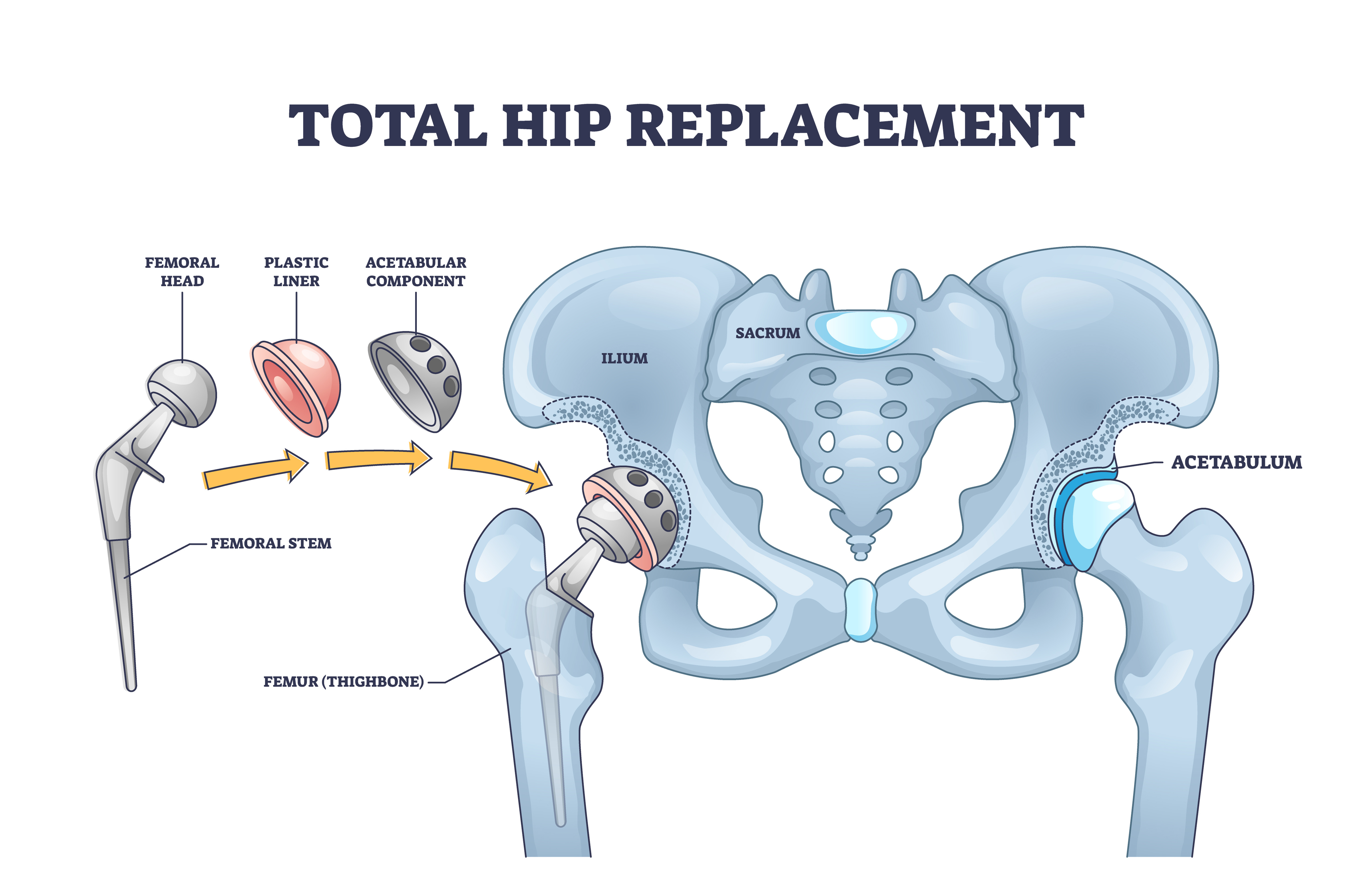 A diagram showing the components involved in total hip replacement surgery.