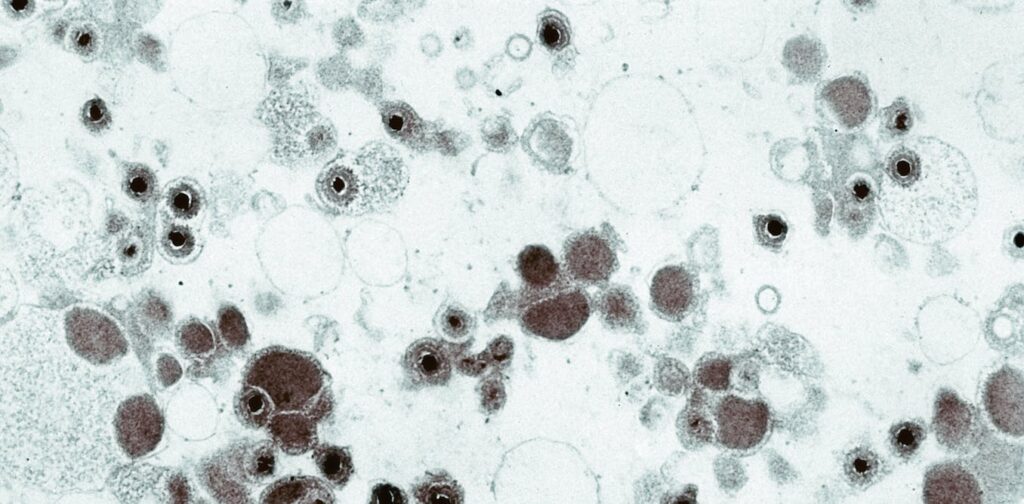Cytomegalovirus lies dormant in most US adults and is the leading infectious cause of birth defects, but few have heard of it