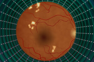 A rendering of a retina with white spots on it.